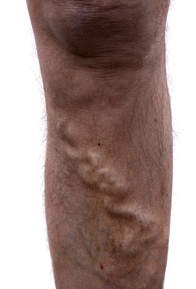 Bulging Veins | Possible Causes | The Vein Institute