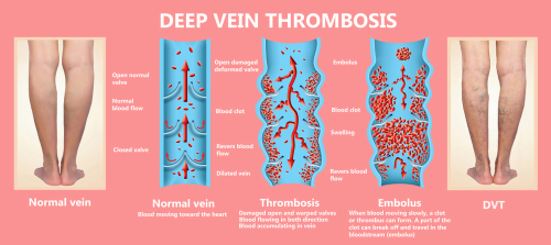 Progression of deep vein thrombosis