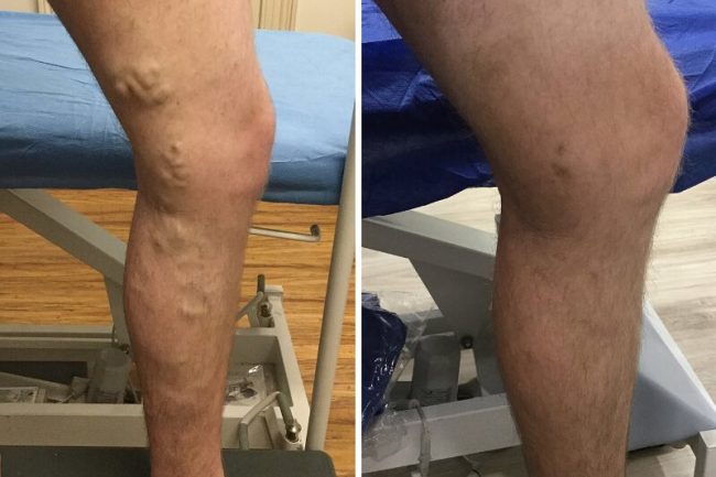 on the left an image of a leg with varicose veins and on the right an image of the same leg after varicose vein treatment and the veins have completely gone.