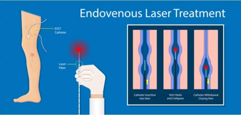 laser for varicose veins. endovenous laser treatment diagram