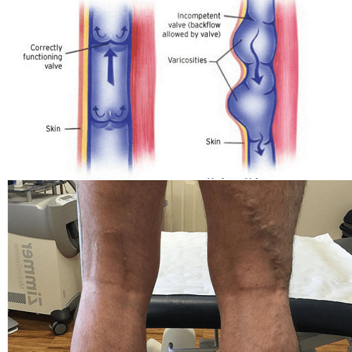 Top and bottom images. The top image is a diagram showing a side-by-side of a varicose vein and a normal vein. The bottom image is a photo of a patient’s varicose leg veins. 