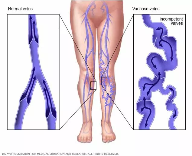 A diagram showing a healthy vein with functioning valves on the left and a varicose vein with malfunctioning valves on the right. In the middle is an illustration of a person’s legs 