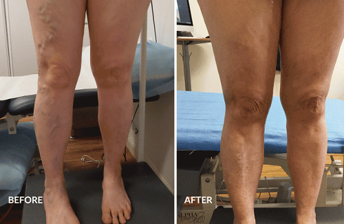 Before and After varicose vein treatment at The Vein Institute