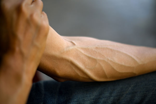 Bulging Veins