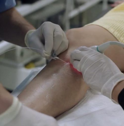 Varice în zona inghinală - Operațiunea varicleoza pe picioare la bărbați