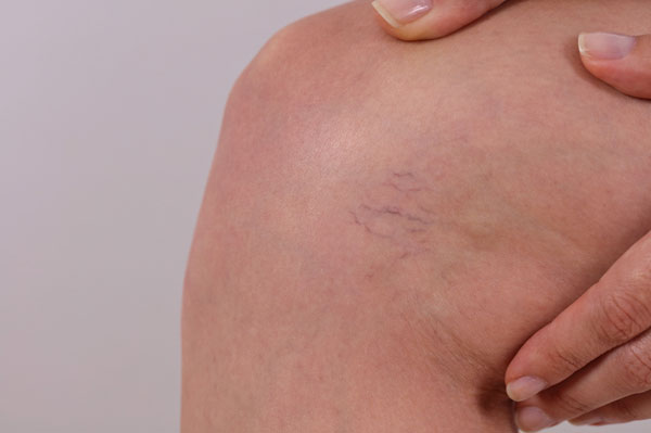 Spider Veins