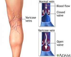 Image of leg with varicose veins including a diagram of a closed vein valve which causes varicose veins and open vein valves when veins are healthy. Related to article on how do venous ulcers form?