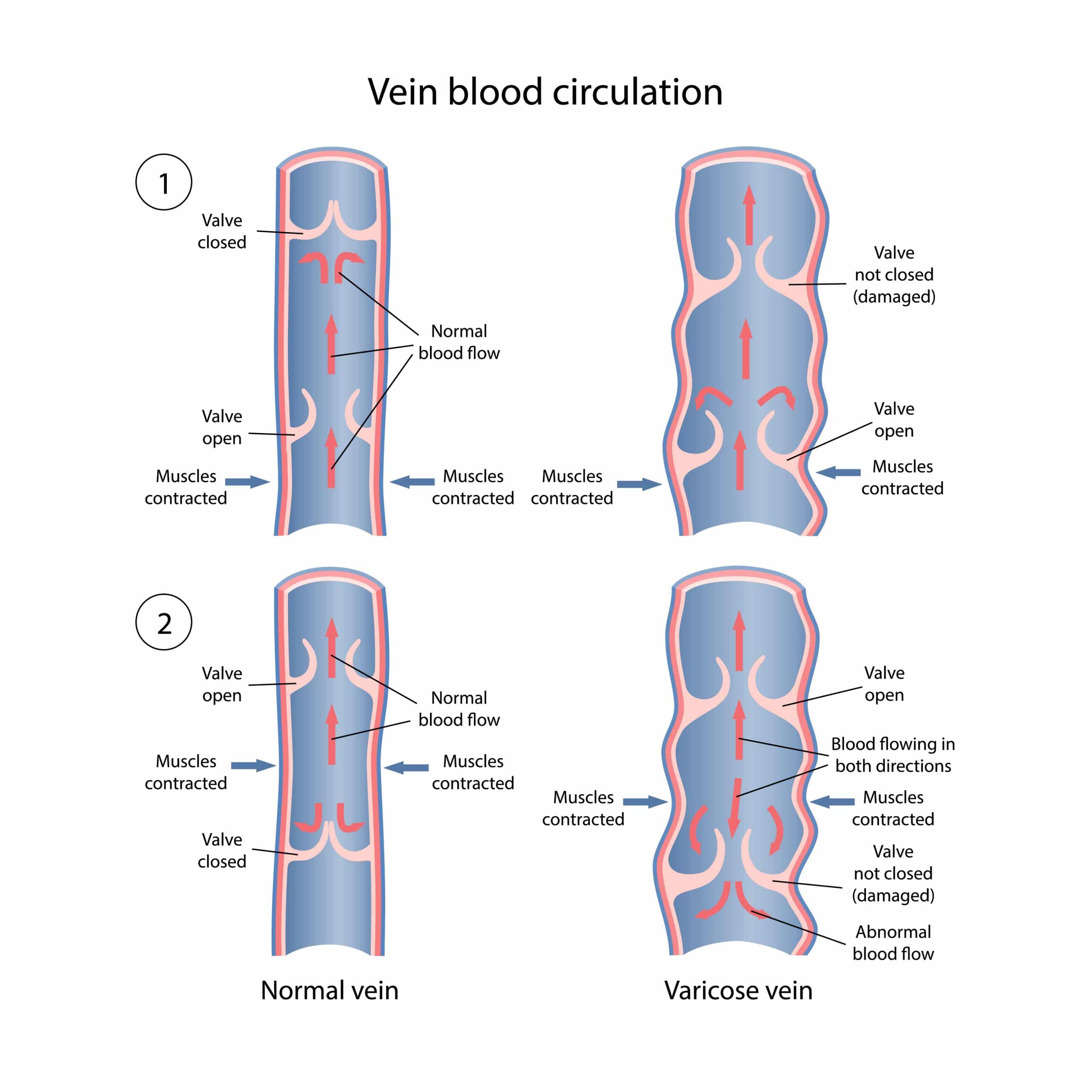 Vein blood circulation and the impact of Cold Weather on Circulation and Varicose Veins
