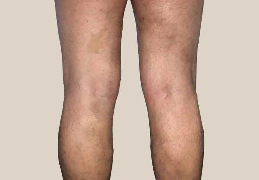 varicose veins After