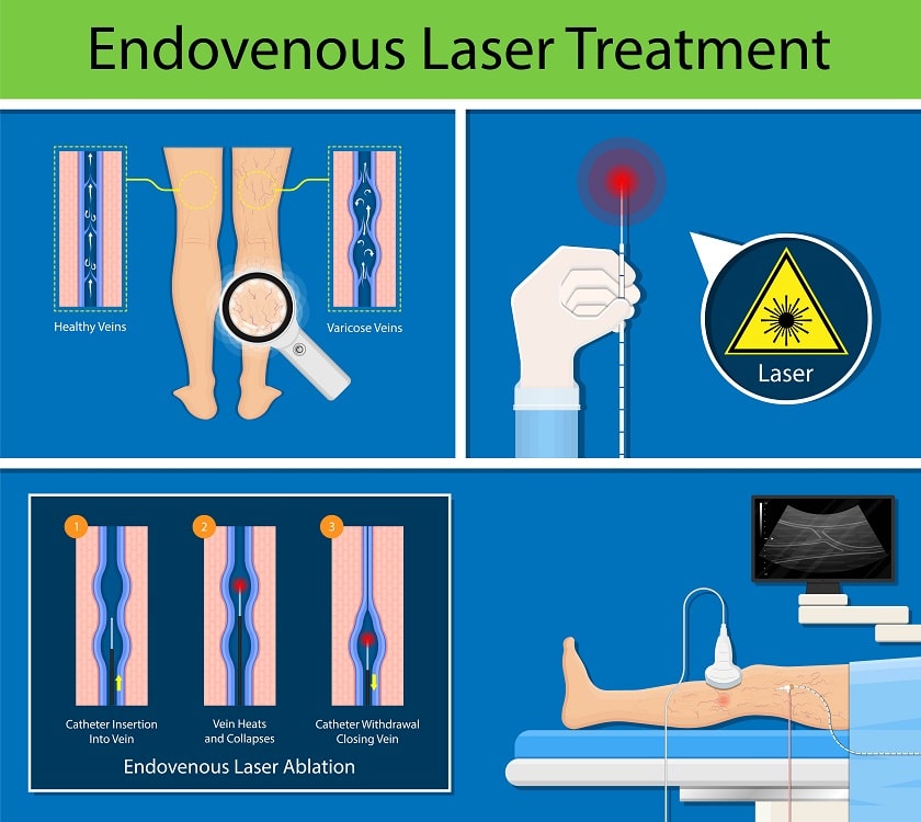 Diagram explaining how endovenous laser ablation works.