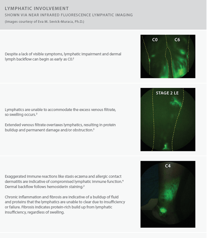 Stages and diagram explaining and showing lympatic involvement.