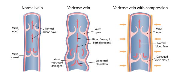 Diagram of a normal functioning vein with healthy vein valves, a varicose vein with damaged vein valves and then an image of how the varicose vein looks when compressed by wearing medical-grade compression stockings.