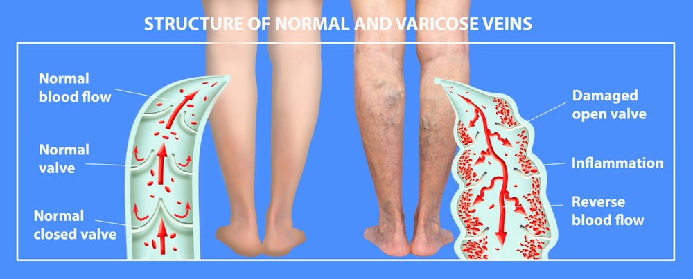 What Causes Varicose Veins in the Feet? Diagram of healthy veins in comparison to varicose veins 