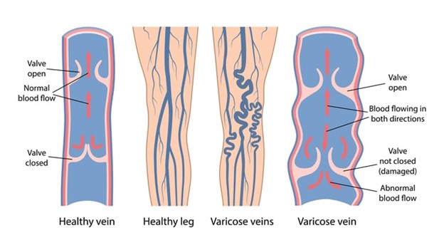 infographic of varicose veins