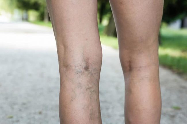 Close up image of legs, the left leg has varicose veins the right leg normal veins