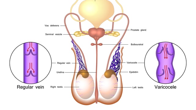 Diagram of varicose veins in the groin in men, known as Varicocele