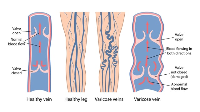 Does Height Cause Varicose Veins? This diagram shows the difference between a healthy vein and a varicose vein