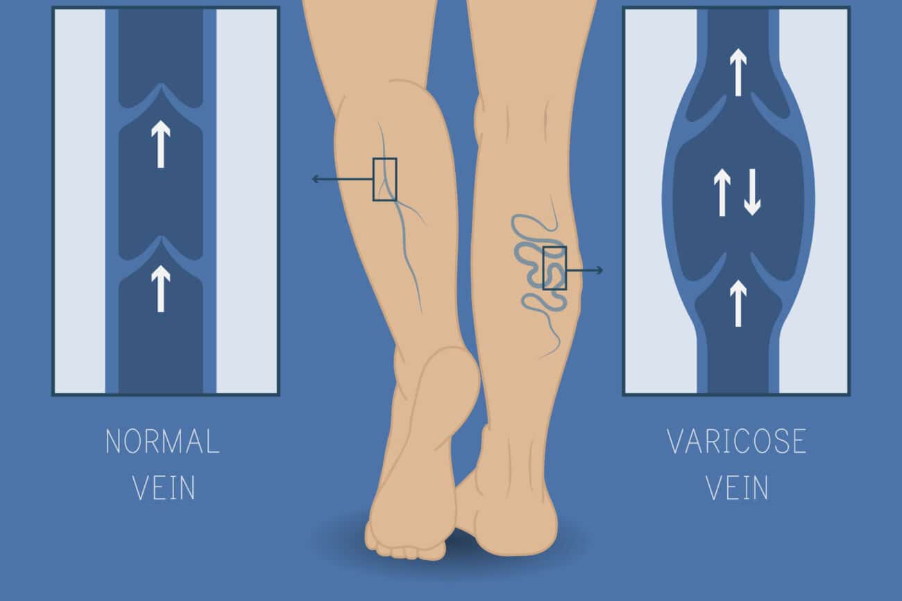 Six Simple Ways to Relieve Painful Varicose Veins