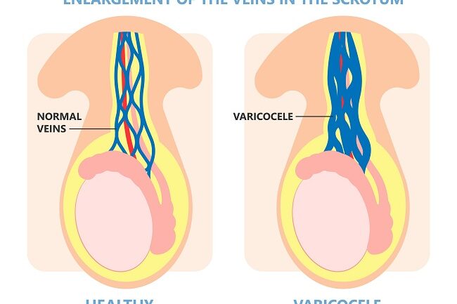 illustration of testicular varicose veins. On the left is a healthy testicle, and on the right is one with a varicocele