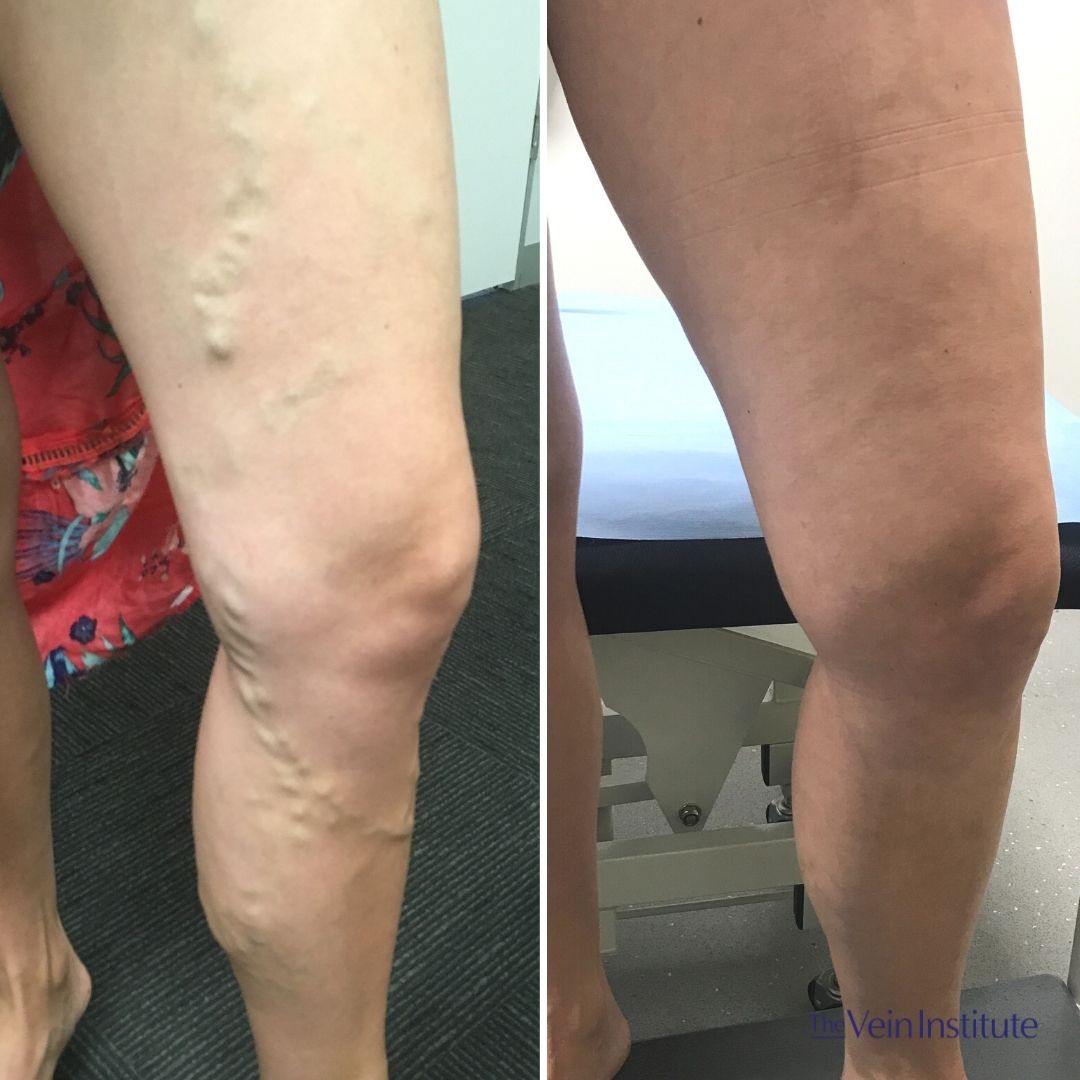 Laser Treatment vs. Surgery: Choosing a Varicose Veins Treatment