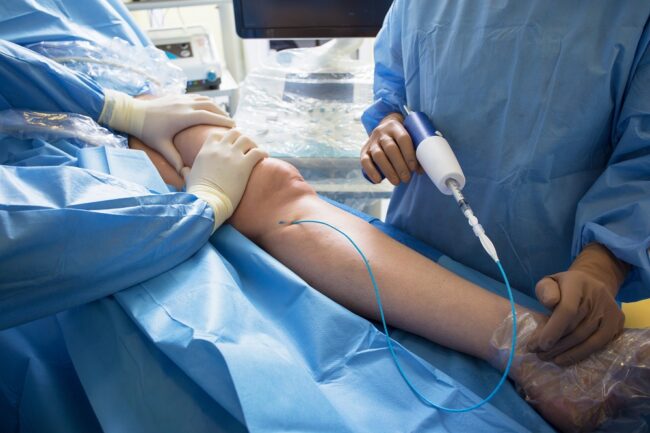 Doctors performing medical superglue treatment for varicose veins using VenaSeal