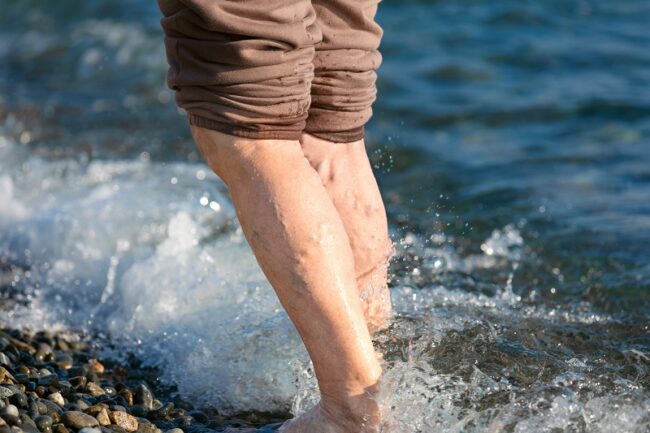 close up of a man's legs. The man has varicose veins in his calves and is standing in the water at the beach to cool off