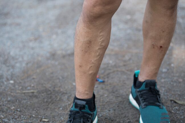 Close up of varicose veins on a man's legs