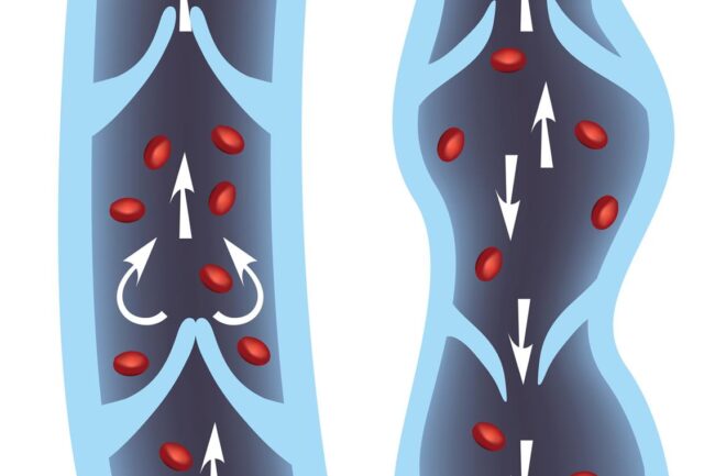 Illustrations of two veins side-by-side. The one on the left is healthy, with straight walls and working valves, the one on the right is unhealthy with curved walls and malfunctioning valves, such as the one people might develop in professions likely to cause varicose veins