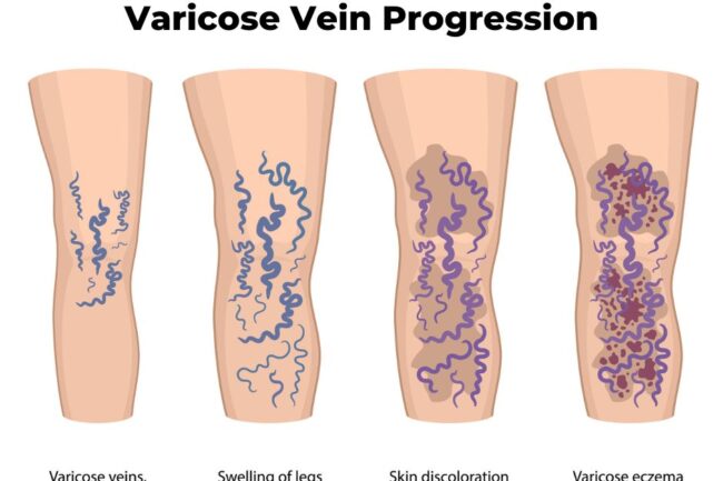 An illustration of the progression of varicose veins and their symptoms if the condition is left untreated