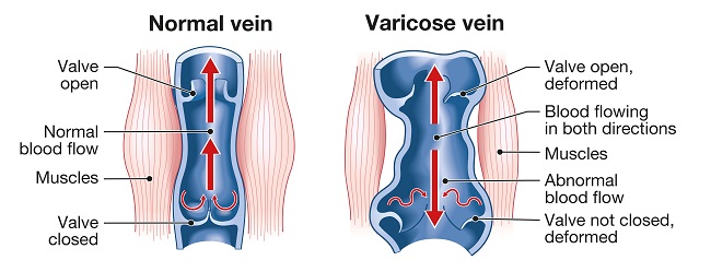 Illustration of two veis side by side. the one on the left is healthy, the one the right is varicose, with malfunctioning valves and bloating that can eventually affect the skin