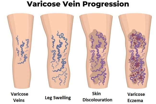 Illustration of the progression of varicose veins on a leg, starting with varicose veins and progressing into swelling, skin discolouration, and varicose eczema