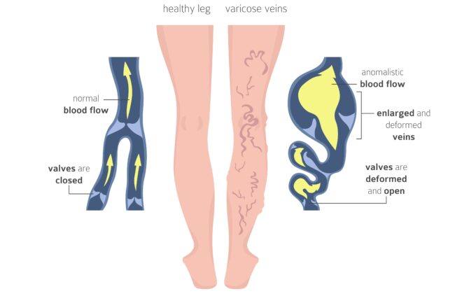 illustration of two legs. One is healthy with good circulation, the other has bad circulation and varicose veins.