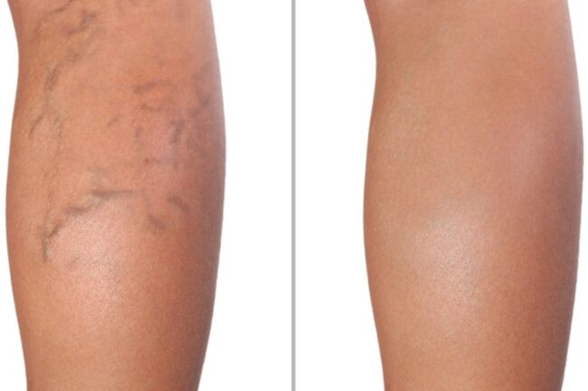 Legs with blue veins versus normal leg veins