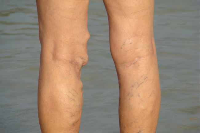 Person with varicose veins standing at the beach. These veins often hurt and come with some other unpleasant symptoms