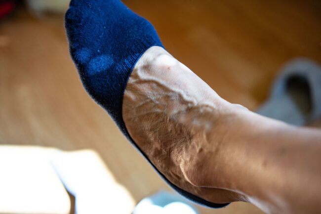 varicose vein in feet with socks