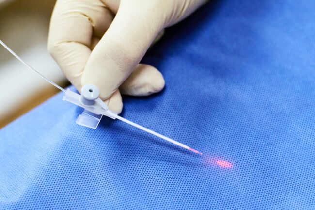 laser technology treatment for varicose vein in feet