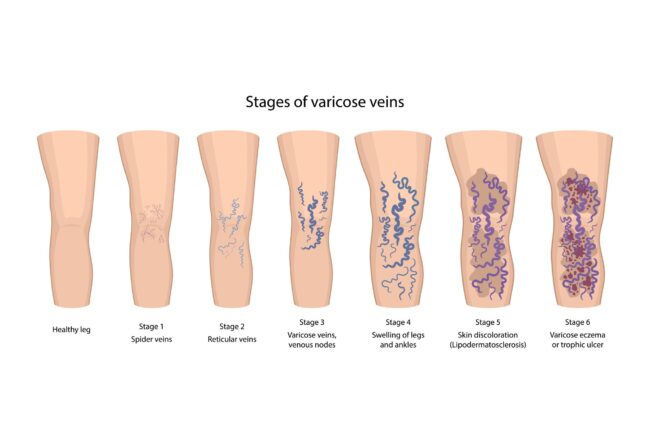 Stages of varicose veins: spider, reticular, nodes, swelling, discoloration skin, eczema, trophic ulcer. Image of healthy and diseased legs.