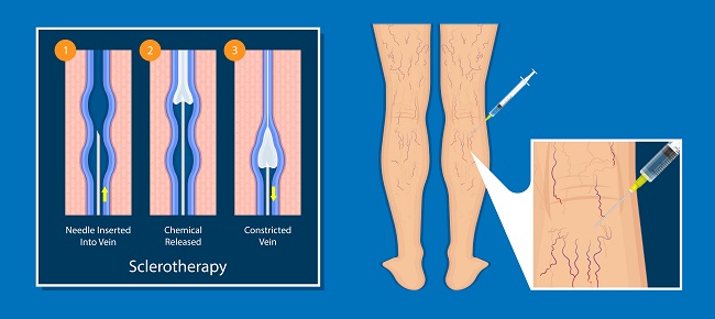 Infographic of the sclerotherapy treatment process for varicose veins