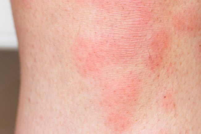 slight allergic reaction to tumescent anaesthetic for varicose vein treatment