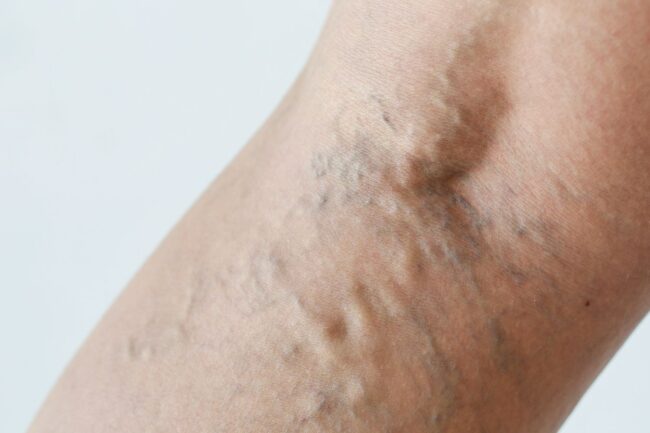 Bulging, greenish varicose veins on the back of a patient's knee